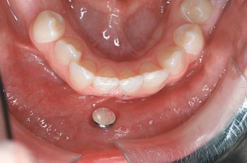 piercing i tungen