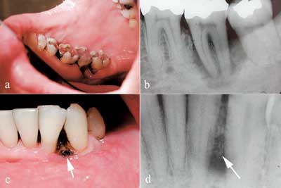 illustrasjon: En pasient med periodontitt, oral candidiasis og uoppdaget hiv-infeksjon