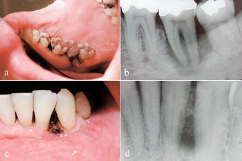 illustrasjon: Mastcellen – en mediator av periodontal vevsnedbrytning?