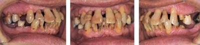 illustrasjon: Periodontal, kjeveortopedisk og protetisk behandling av en pasient med redusert tannsett