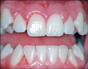 illustrasjon: Diagnostikk av periodontale sykdommer
