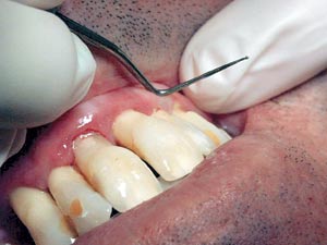 illustrasjon: Periodontal vedlikeholdsbehandling