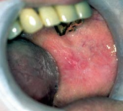 illustrasjon: Kontaktallergisk reaksjon overfor dentalt gull – kasuspresentasjon
