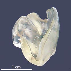 illustrasjon: Aksidentell svelging av ei incisal bittskinne