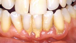 illustrasjon: TSE modul 4: Periodonti