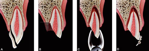 illustrasjon: Dentale og orale skader