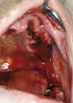 illustrasjon: Akutte skader og komplikasjoner ved behandlingsprosedyrer i munnhulen
