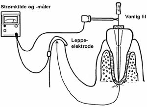 illustrasjon: Elektronisk apekslokalisering