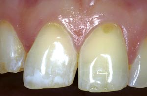 illustrasjon: Dental erosion