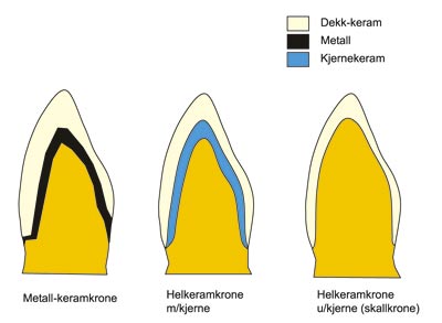 illustrasjon: Keramer som tannrestaureringsmateriale