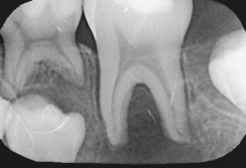 illustrasjon: Arteriovenøs malformasjon i underkjeven