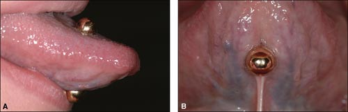 illustrasjon: Piercing – ikke bare til glede