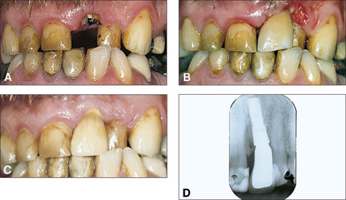 illustrasjon: Direkte innsetting og belastning av implantater hos pasienter med rotfrakturer og tannslitasje