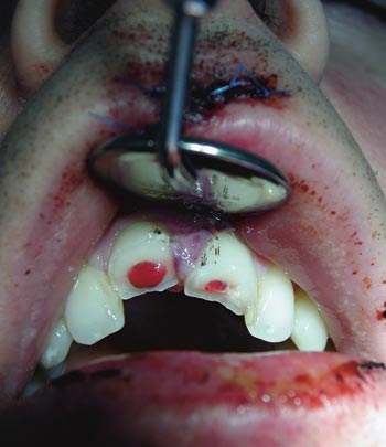 illustrasjon: Vurdering av tannskader ved legevakt