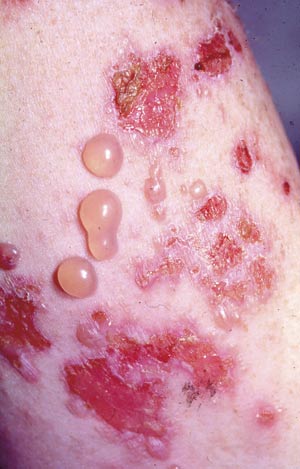 illustrasjon: Sykdommer som affiserer hud og munnslimhinne