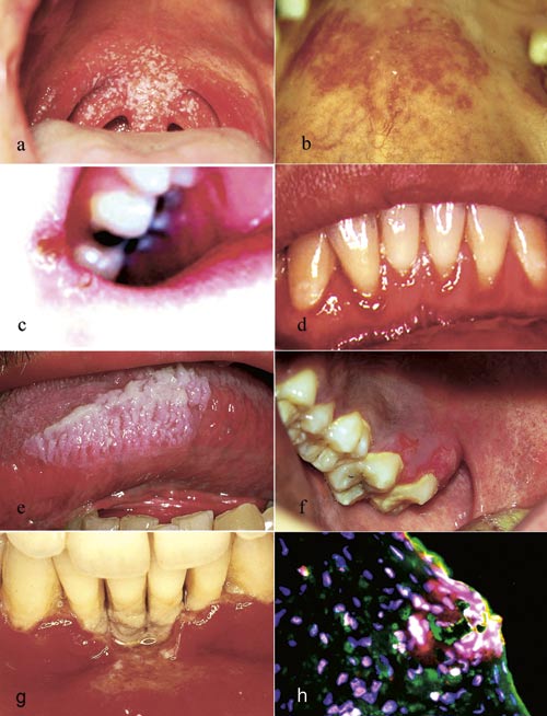 illustrasjon: Orale manifestasjoner ved HIV-infeksjon