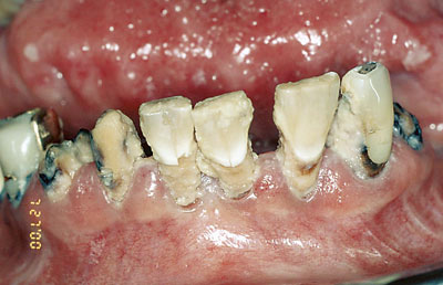 illustrasjon: Hvordan påvirkes munnhulen av kreftbehandling?