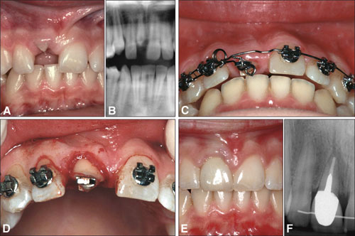 illustrasjon: Oral rehabilitering av barn