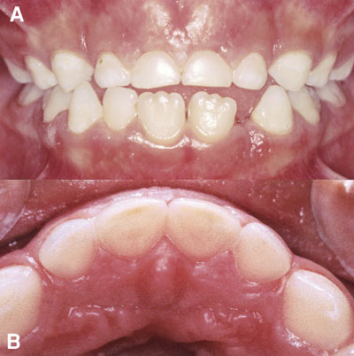 illustrasjon: Dental erosjon. Moderne tannslitasje og ny folkesykdom