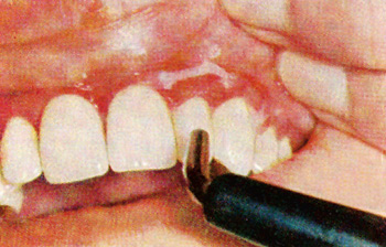 illustrasjon: Deskvamativ gingivitt