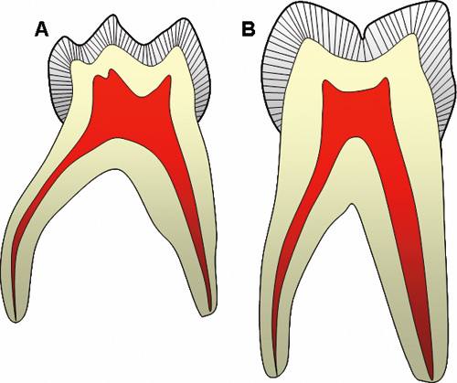 illustrasjon: Endodonti i primære tenner