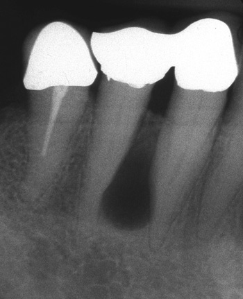 illustrasjon: Keratocystisk odontogen tumor – keratocysten har fått nytt navn