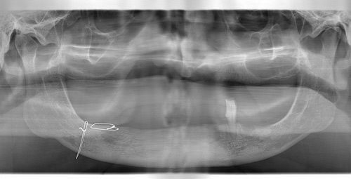 illustrasjon: Mandibulær dekkprotese forankret på to implantater