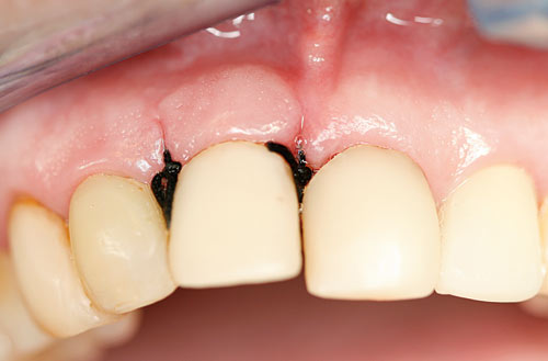 illustrasjon: Fremmedlegeme som årsak til periodontalt festetap