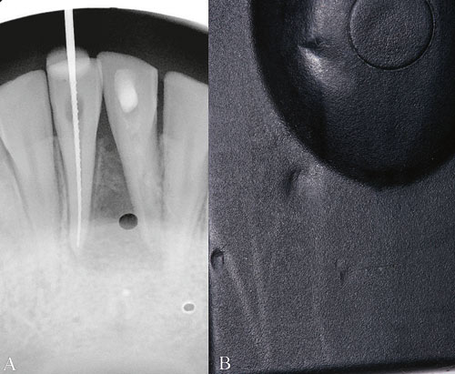 illustrasjon: Film og digitale intraorale røntgenreceptorer