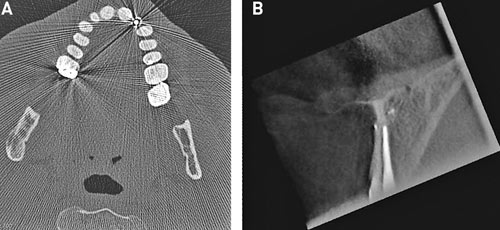 illustrasjon: Computed tomography in oral and maxillofacial radiology