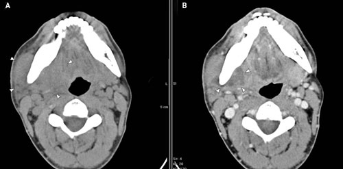 illustrasjon: Kontrastmedel inom odontologisk radiologi