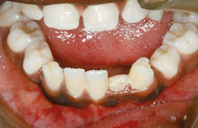 illustrasjon: Fjerning av tannanlegg i afrikansk folkemedisin