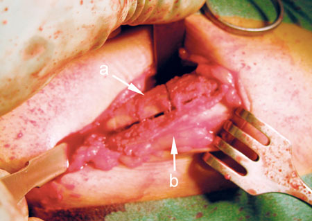 illustrasjon: Implantatbehandling i atrofiske overkjever rekonstruert med hoftebenstransplantat