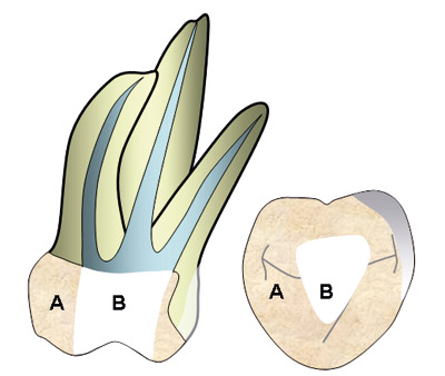 illustrasjon: Temporære materialer og lekkasje i forbindelse med endodontisk behandling