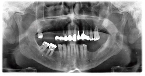 illustrasjon: Dental implantatbehandling – pasientvurdering og behandlingsplanlegging