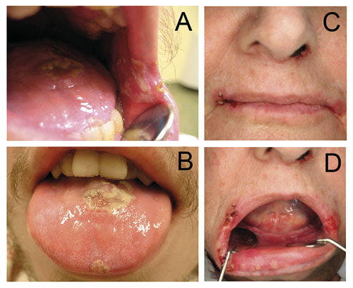 illustrasjon: Cyto­sta­tika og oral helse