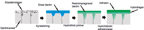 illustrasjon: Aktuella tendenser inom dental adhesion