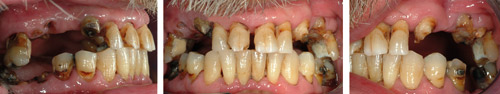 illustrasjon: Periodontal forbehandling - en forutsetning for et vellykket resultat ved innsetting av tannimplantater på periodontittdisponerte pasienter