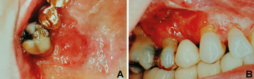 illustrasjon: Munnhulekreft, dentale biomaterialer og inflammasjon