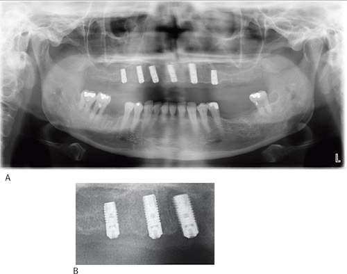 illustrasjon: Implantatoverlevelse ved Avdeling for oral kirurgi og oral medisin, Det odontologiske fakultet, Universitetet i Oslo 2008 - 2010