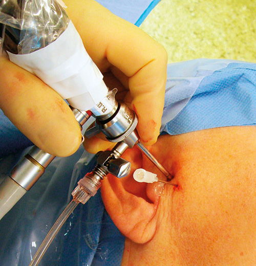 illustrasjon: Er artroskopi av kjeveleddet effektivt mot smerter og gapevansker?