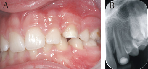 illustrasjon: Endodontisk behandling av umodne permanente tenner