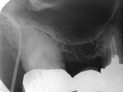 illustrasjon: Diagnoseavvik i endodontisk behandling