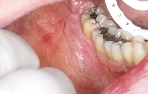 illustrasjon: Allergi og dentale materialer