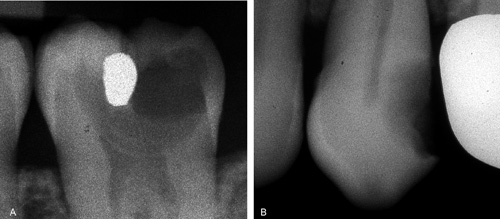 illustrasjon: Behandling af profund caries - baseret på evidens fra nyere kliniske undersøgelser