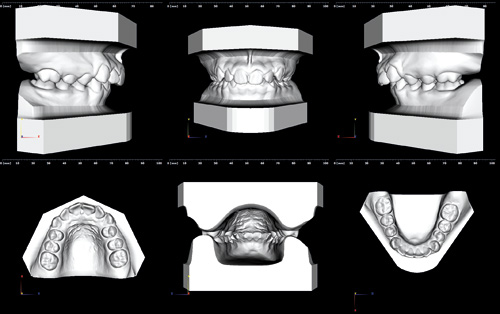 illustrasjon: Anvendelse af digitale dentale og 3-D virtuelle modeller i ortodontiske, ortokirurgiske og rekonstruktive kirurgiske behandlinger