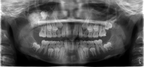 illustrasjon: Kasusrapport om en sjelden variant av den vanligste odontogene tumor