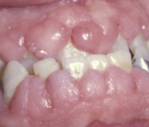 illustrasjon: Legemiddelindusert gingival overvekst (LIGO)