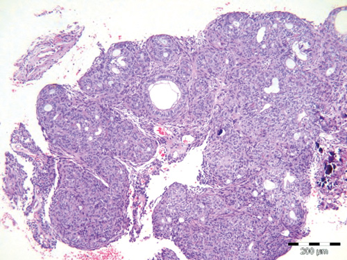 illustrasjon: Adenomatoid odontogen tumor: «To tredje-delstumoren»