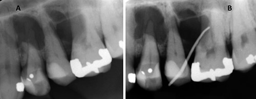 illustrasjon: Sentralt odontogent fibrom - en sjelden, men viktig svulst for tannleger